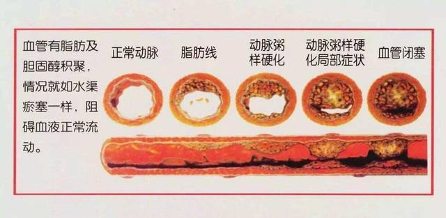 60岁的赵阿姨主动脉硬化,医生说不用担心,这是