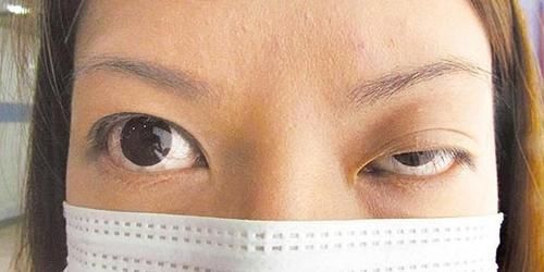 肉毒素能治面肌痉挛吗_【快资讯】