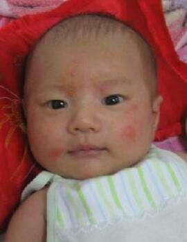 水痘、手足口、荨麻疹、皮炎、湿疹如何区分及