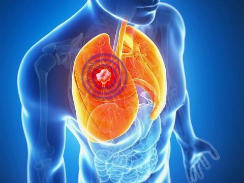 10种不常见的肺癌征兆,更值得大家警惕