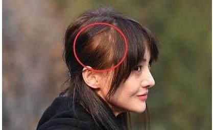 明星脱发谁更强?杨乐乐头顶亮,杨幂要植发,郑