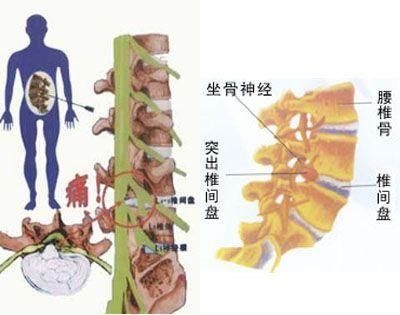 腰椎间盘突出什么情况下需要立即就医?