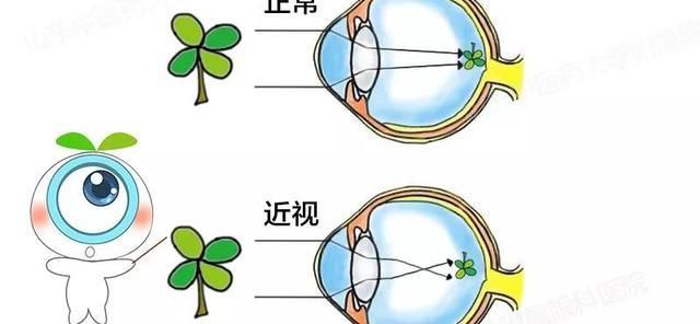 近视、远视、散光是什么感觉?_【快资讯】