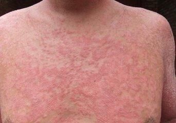 成人湿疹日常护理的要点有什么,这里有你的答