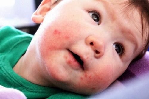 识别宝宝湿疹,口水疹,尿布疹儿童皮疹和皮肤状