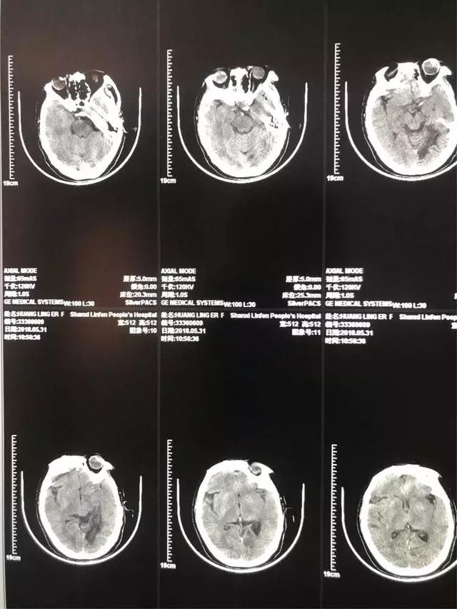 脑血栓机械取栓三例