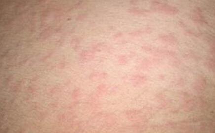 深圳肤康皮肤病研究院: 过敏性的荨麻疹 引起的