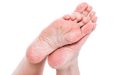 脚后跟干裂疼痛,是缺水?别只看表象!