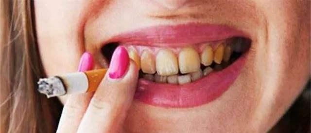 门牙缝发黑蛀牙的图片