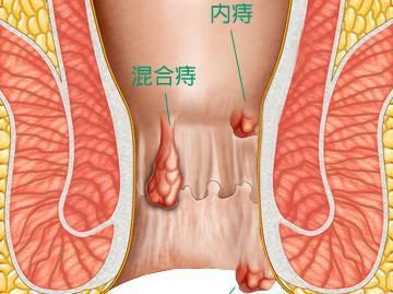 再也不敢动刀治痔疮，这个方法，再用毛巾热敷，痔疮竟然就消失了