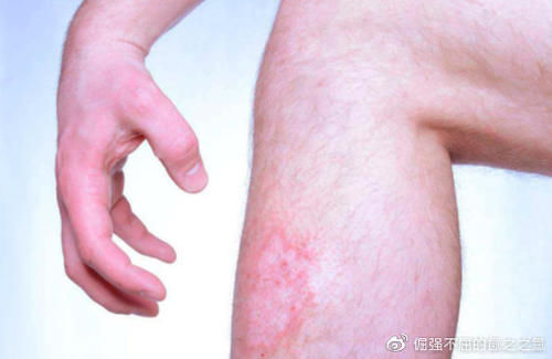 湿疹治疗选购指南：选择适合的护理产品