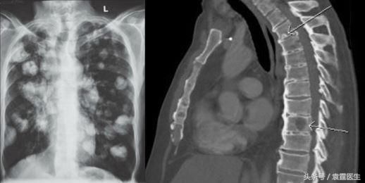 癌症怎么转移 t01b1b40ecc7a32ad74.jpg