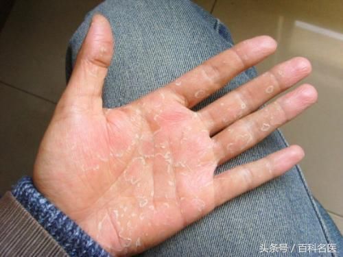 皮,长手癣是怎么引起的?手癣会传染到脸上吗?