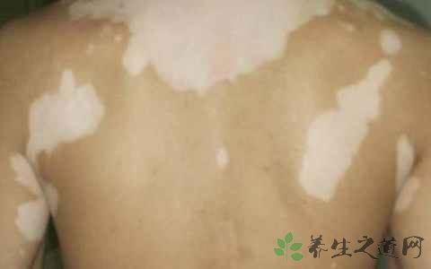 白癜风用什么药效果好