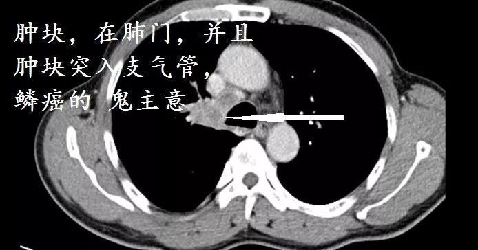 肺CT也会装酷:如何从CT上看出肺癌的病理类型?