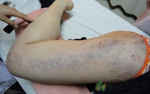 皮炎和湿疹有什么区别