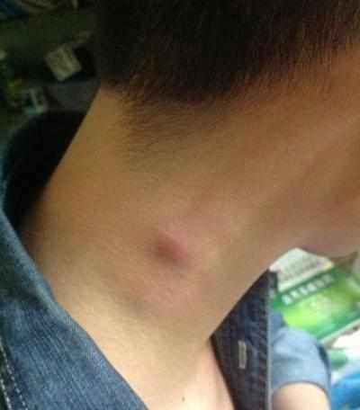 身上出现这些疙瘩万万要小心,是癌症出现的前