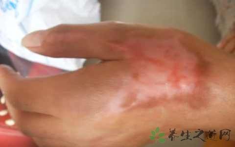 烫伤为什么要用弹力绷带