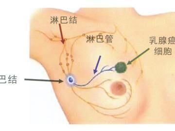 腋窝淋巴结肿了，要紧吗?