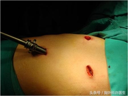 胸腔镜微创手术，为什么切口还是那么疼?