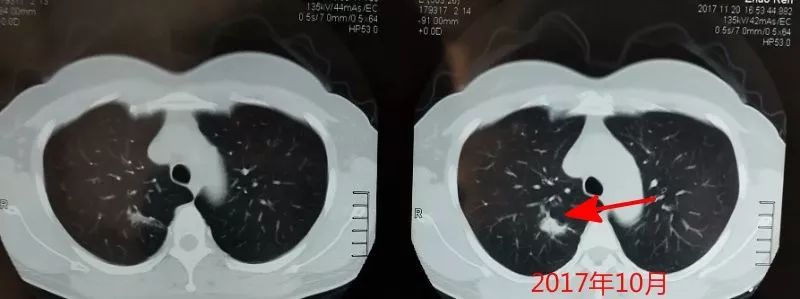 发现肺部磨玻璃样结节怎么办,会不会是肺癌?