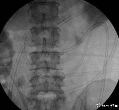 25岁男子腹痛剧烈，医治无效，当医生拉下他的裤子才发现病因