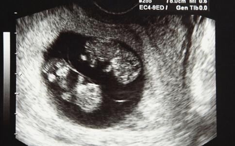 22岁孕妇检查是双胞胎,出生后孩子是胎中胎,把