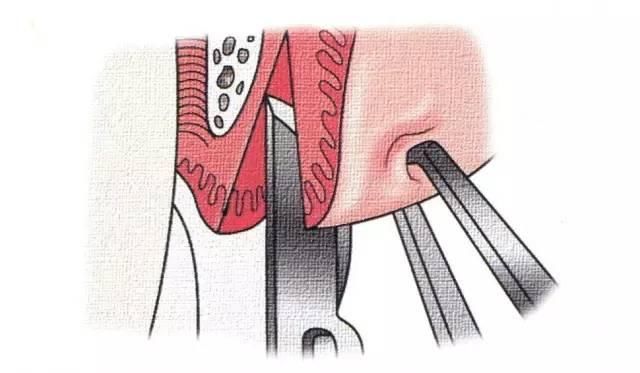 牙周技能翻瓣、搔刮、根面刮治与平整