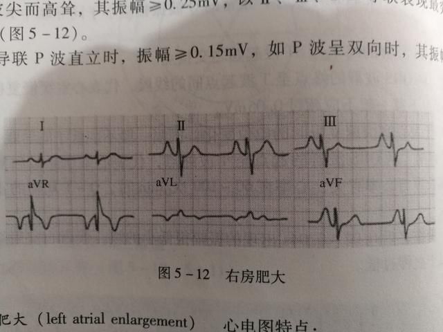 如何看懂心电图一览表 t01cf432a4de3eb13ef.jpg