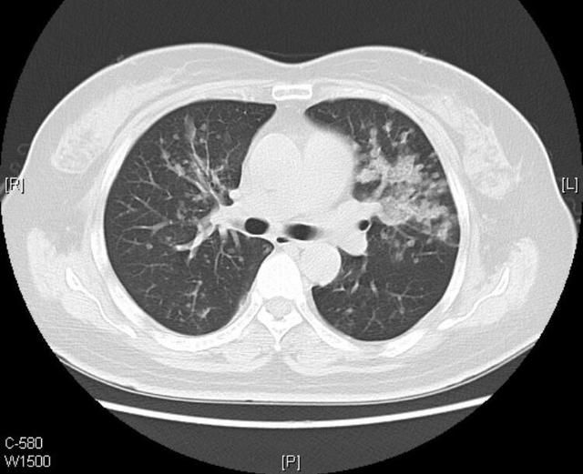 晚期肺癌已经生存5年抗癌斗士案例