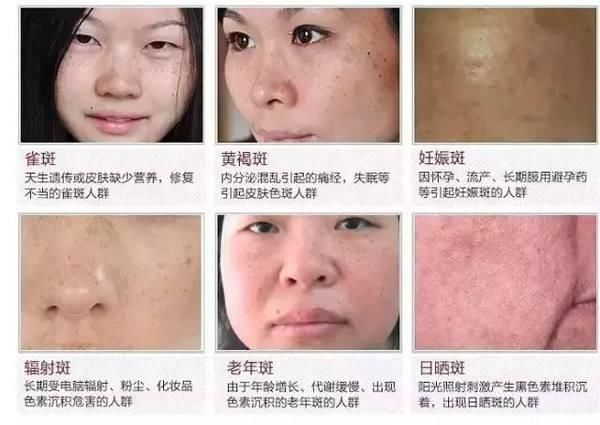 烂香蕉千万别扔,捣碎加上 维E 敷脸,祛斑祛皱_