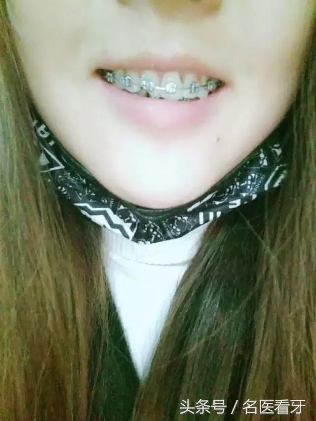 牙齿矫正|拥挤不齐,门牙缺失!人家说戴牙套瘦多