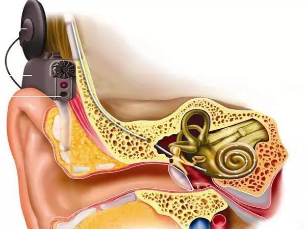 人工耳蜗丢失需要开颅?专家:没必要,重配要20