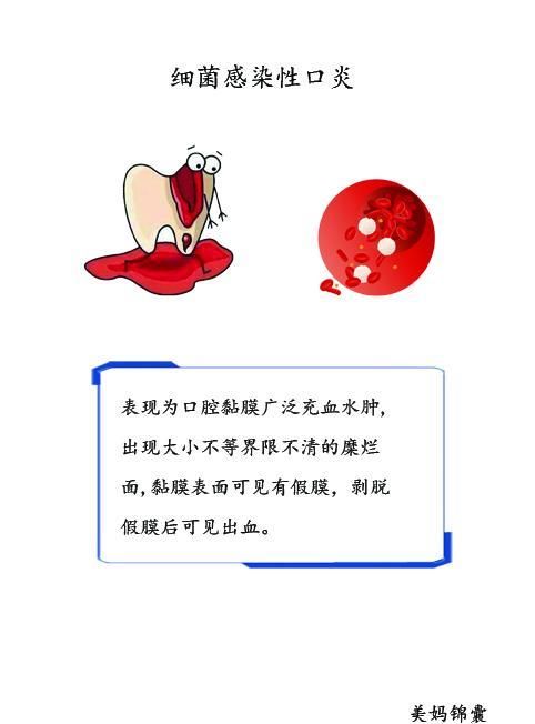 三种小儿口腔炎了解一下