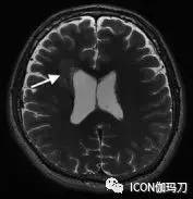 放射外科治疗脑动静脉畸形