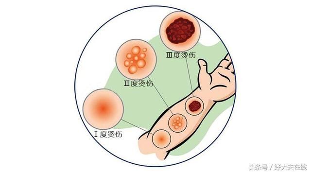 牙膏能祛痘、止痒、治烫伤?你竟被骗了这么多年