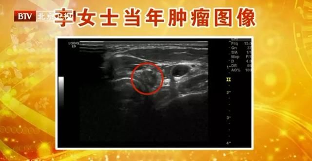 它是一种能摸到的恶性肿瘤,用手摸一摸,自检这种“危险分子”!