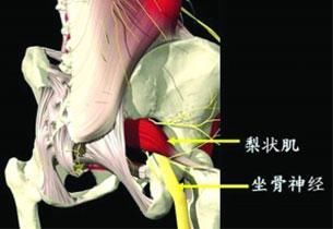 放射性臀部疼痛伴下肢，不是腰椎间盘突出却是因为它