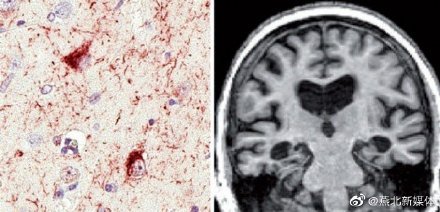 美媒:科学家确认新型痴呆症,或比阿尔茨海默病