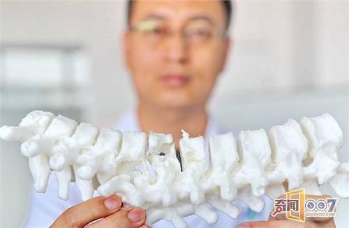 巧用3D打印技术 外科医生完成高难度胸椎手术