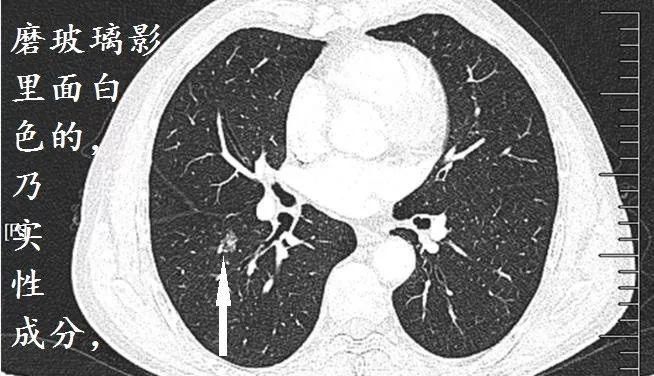 肺CT也会装酷:如何从CT上看出肺癌的病理类型?