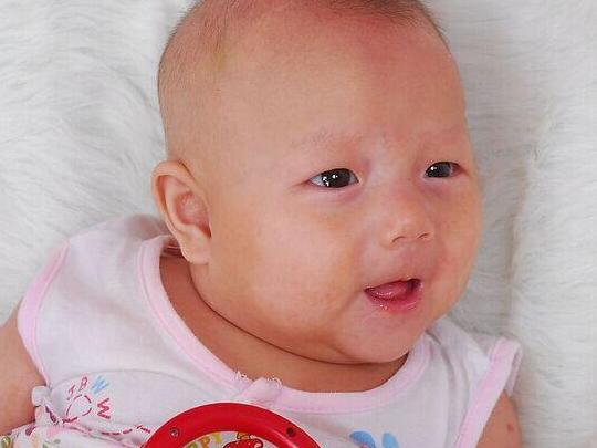 1岁女宝满面白斑,确诊为婴幼儿白癜风,只因宝