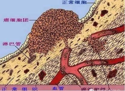 癌症喜欢盯这一类人？！很多人都不知道的正确防癌方法