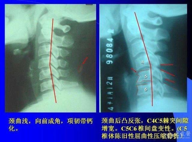 睡觉时不枕枕头能治颈椎病吗?