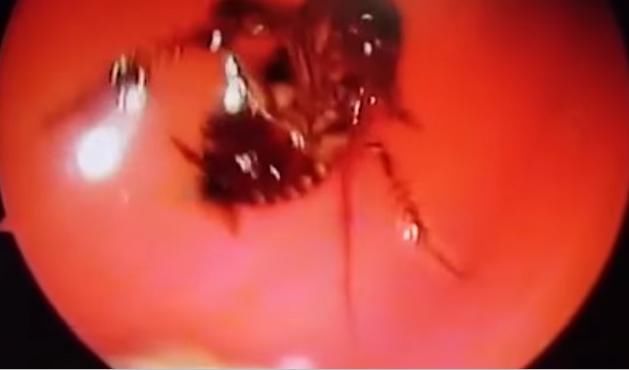 妇女直喊头疼前去检查,发现是脑袋内进了一只