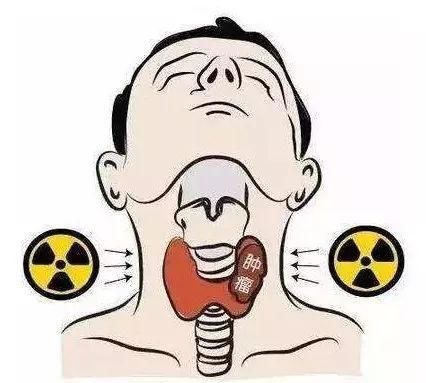 中国首例核辐射案受害者离世,凶手是他无意捡