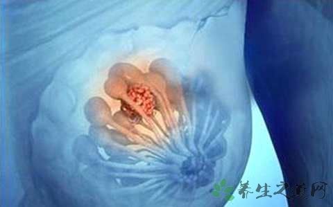 乳腺肿瘤可以哺乳吗