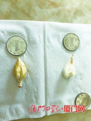 厦门市民煮鱼时疑现鱼宝 专家:或是鱼骨骨质