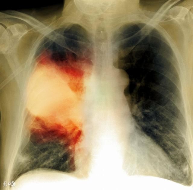 北京高新戒毒中心:冰毒对哮喘病人的危害!