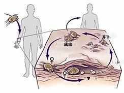 告诉你疥疮是怎么引起的, 附最快治疗方法。